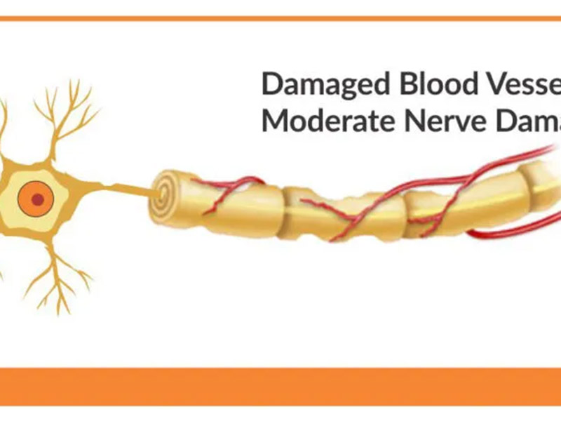 Featured image for “Angiogenesis – An Important Concept in Neuropathy”