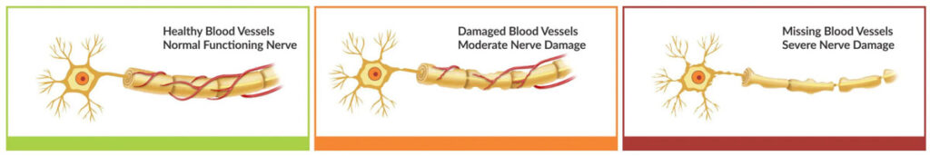 nerve damage chart